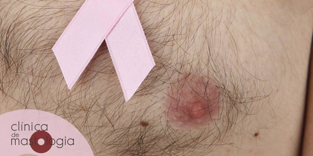 Câncer de mama pode dar em homens, sim!