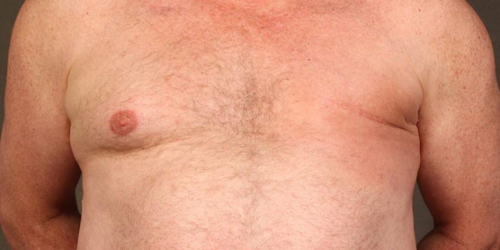 Câncer de mama também atinge os homens