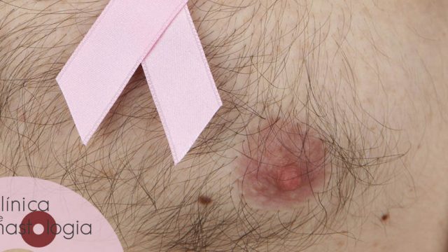 Câncer de mama pode dar em homens, sim!
