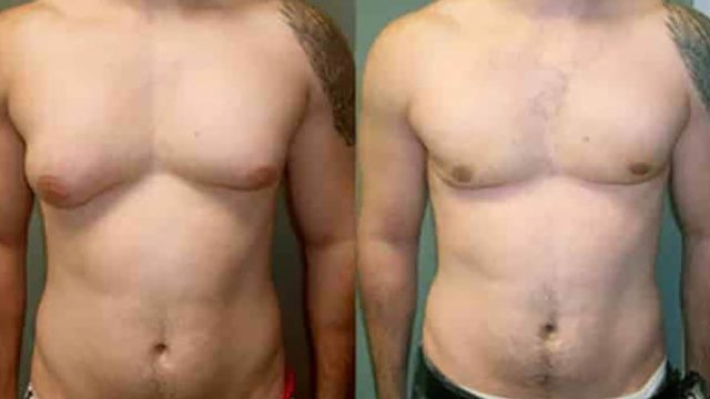 Homem com glândulas mamárias excessivamente grandes
