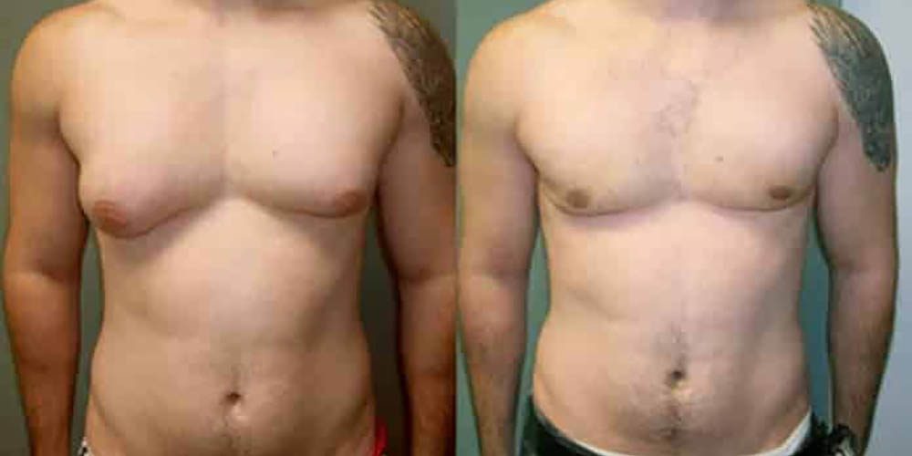 Homem com glândulas mamárias excessivamente grandes