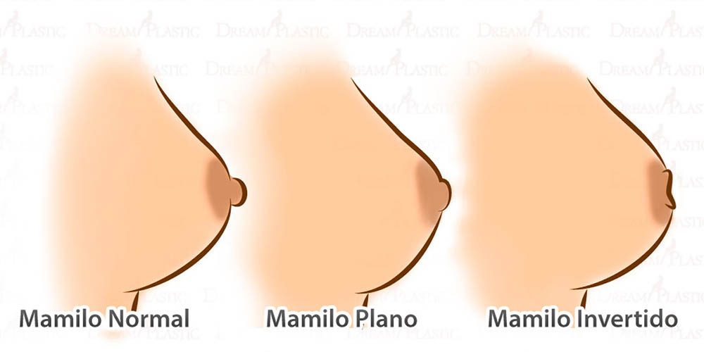 Tenho mamilos invertidos. Devo me preocupar?