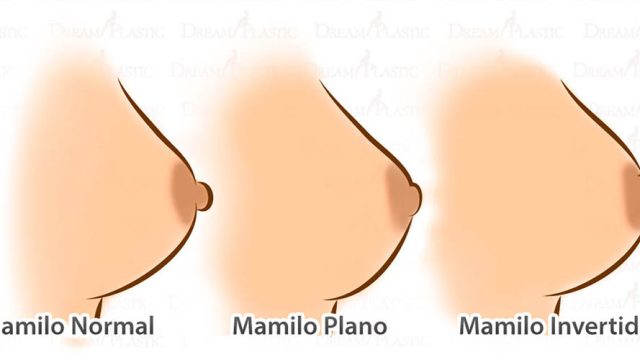 Tenho mamilos invertidos. Devo me preocupar?