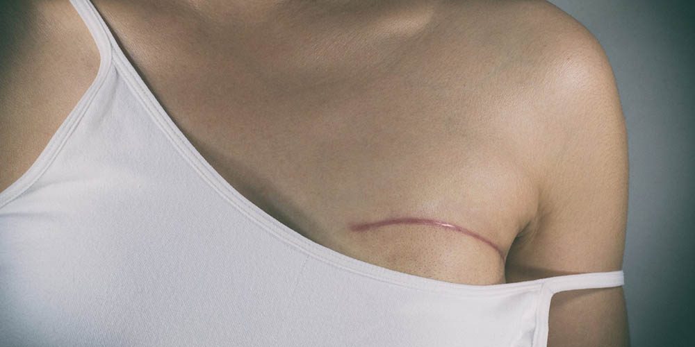 Fiz mastectomia e estou grávida. Que cuidados devo tomar?