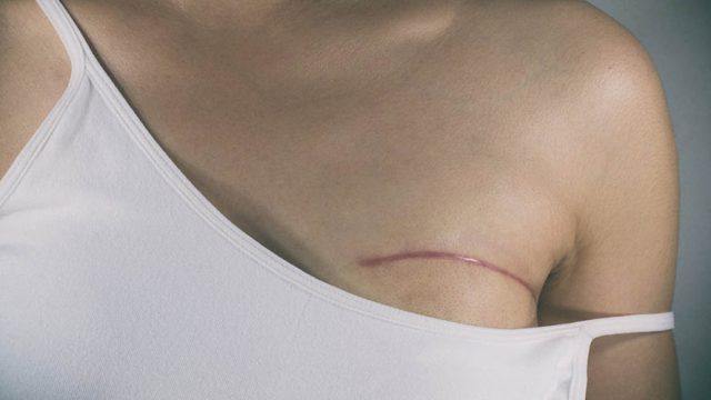 Fiz mastectomia e estou grávida. Que cuidados devo tomar?