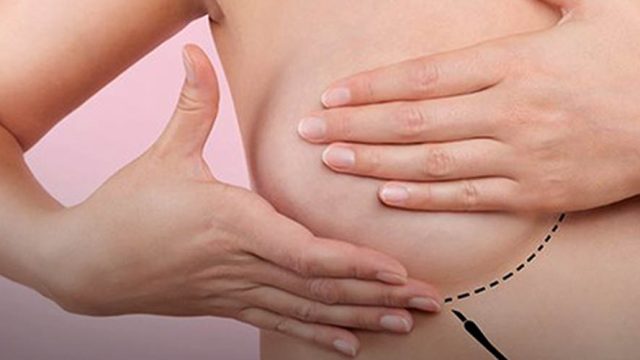 Operar o câncer e restaurar a mama na mesma cirurgia