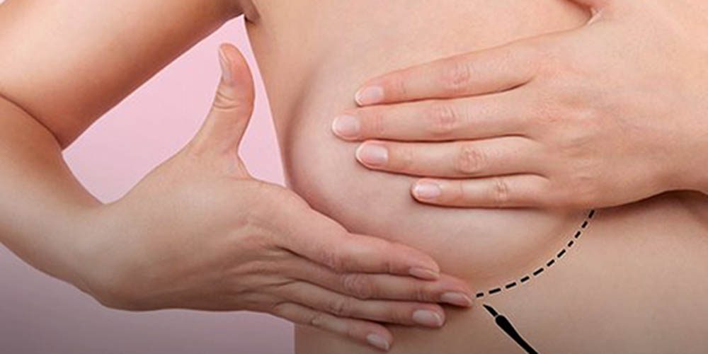 Operar o câncer e restaurar a mama na mesma cirurgia