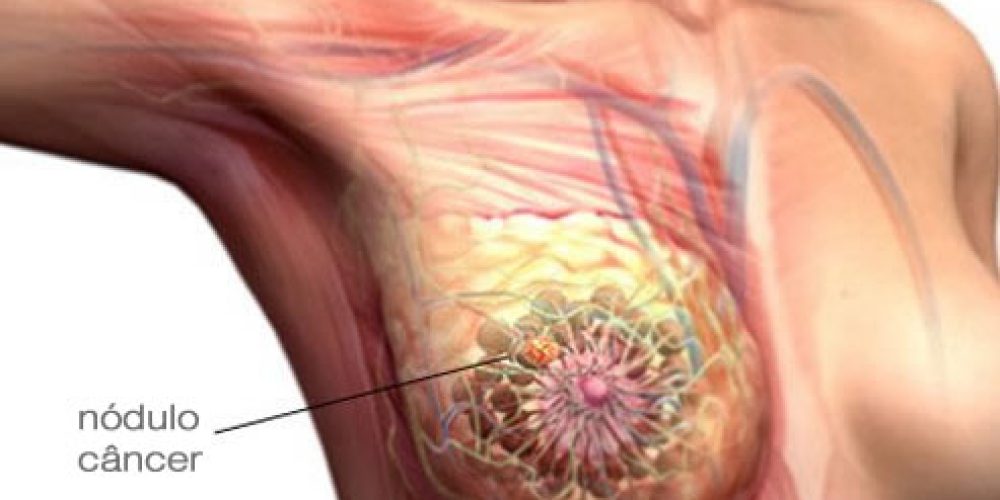 O risco de desenvolver câncer de mama aumenta com a idade?
